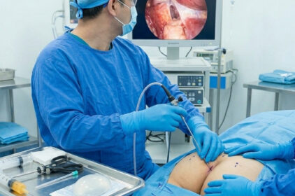 Nâng mông nội soi